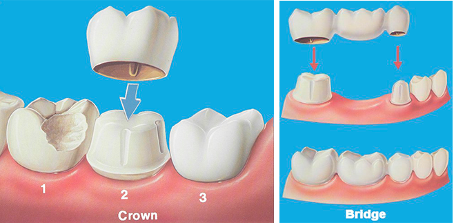 Evolution Dental Crown and Bridge