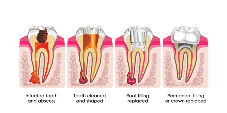 Evolution Dental Root Canal