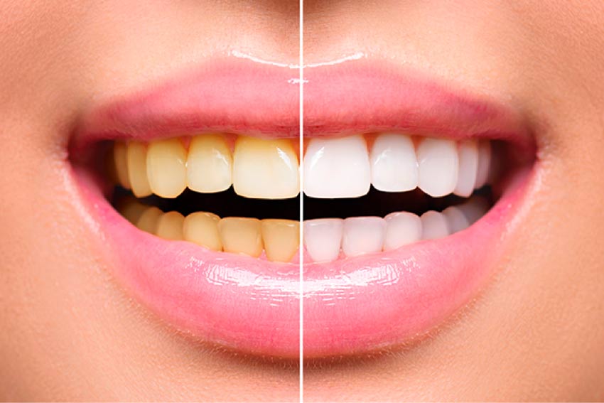 Evolution Dental Teeth Whitening